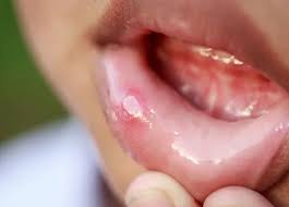 Image result for oral thrush symptoms roof of the mouth