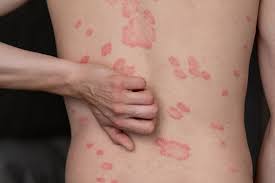 Image result for psoriasis
