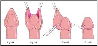Circumcision Definition Purpose Description Risks Normal Results
