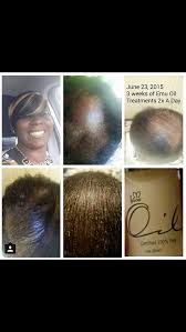 Emu oil for hair loss after 3 months effects. I Use This Organic Emu Oil Product Everyday It Does Everything From Smoothing Clearing Your Skin To Growing Your Hair Emu Oil Oil Treatments Hair Restoration