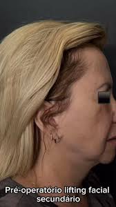 #cirurgiaplástica #lipliftsurgery #browlifting