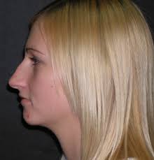 Achieve that perfect nose with our advanced nose reshaping tools. Want A Permanently Perfect Nose Consider Nose Job Surgery