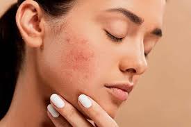 Top Homeopathic Doctors For Pimples Treatment in Takrera, Bilaspur Himachal  Pradesh