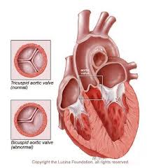 Bicuspid Aortic Valve This Is What I Have Going On Guess I Actually Born With A Broken Heart Lo Bicuspid Aortic Valve Heart Surgery Recovery Aortic Stenosis