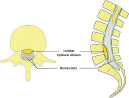 Image result for Spinal Epidural Abscess