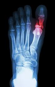 A broken toe can be painful, but you do not usually need to go to hospital. Common Symptoms And Treatment Of A Fractured Toe
