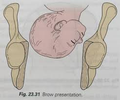 Image result for Brow Presentation