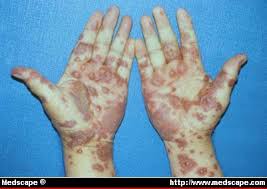 Stevens Johnson Syndrome Medical Blog