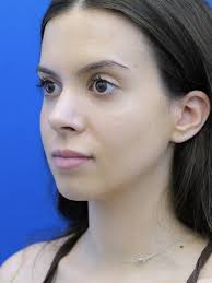 Cases in Rhinoplasty Preservation