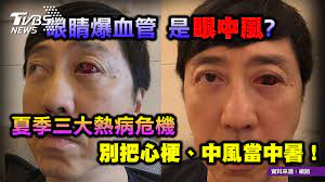 區分中風的類型 中風症狀的嚴重度會因腦組織受損的位置和大小 而異 出血性中風因為血管突然破裂，症狀一般發生很 快，可能數秒到數分鐘就很嚴重。但是小出血症 狀也可以很輕微 缺血性中風變異很大，可以快到數分鐘一來就很 嚴重，也可能拖延1、2日慢慢惡化 ä¸­é¢¨ ä¸­æš' åˆ†ä¸æ¸…æŽŒæ¡é—œéµé¿å…éŒ¯éŽé»ƒé‡'æ¶æ•'æœŸ å¥åº·2 0 é„­å‡±äº' åº¾æ¾„æ…¶ Tvbsæ–°èžç¶²
