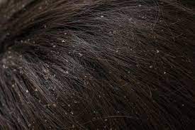 It uses advanced technology to ensure. Dandruff Vs Dry Scalp Causes Treatment And Prevention