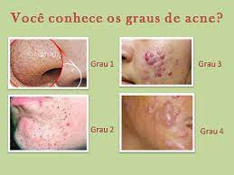 How do dermatologists diagnose acne? Clinica Vitally Voce Sabia Que Voce Pode Se Enquadrar Em ÙÙŠØ³Ø¨ÙˆÙƒ