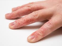 Image result for Hand Dermatitis