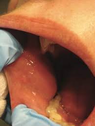 Image result for Leukoedema