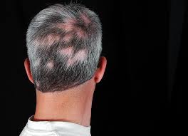 Plz Re Pin For Later Hair Transplant Hair Loss Your Hair