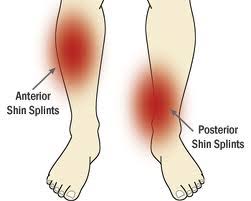 Image result for Shin Splints