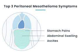 Mesothelioma symptoms may take decades to present after asbestos exposure. Mesothelioma Cancer Symptoms Early Warning Signs