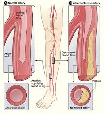 Difference Between Pad And Pvd Difference Between