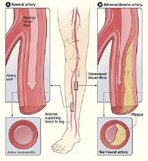 difference between pad and pvd difference between