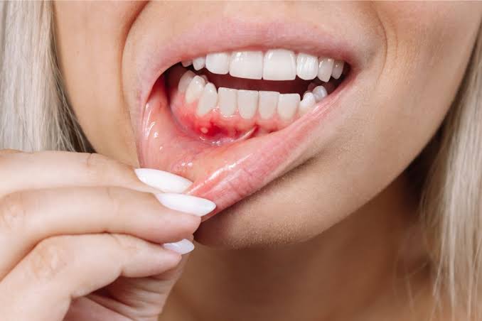 Denture Stomatitis: Causes, Symptoms & Prevention Tips