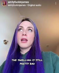 A social media influencer who went viral for having six ribs removed to  achieve a smaller waist has announced they intend to have them fashioned  into a crown. 👑 Emily James, who