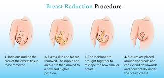 Yes, though certain conditions need to be met. Breast Reduction Are You A Candidate Cost Recovery Etc