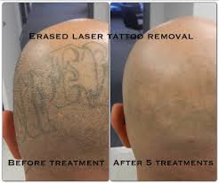 Yes, you read that correctly. Remove Henna Tattoo Faster Oktober 2017
