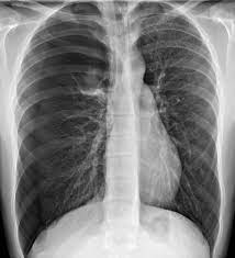 A pneumothorax occurs when air leaks into the space between your lung and chest wall. Pneumothorax Pulmonary Disorders Msd Manual Professional Edition