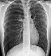 Symptoms of pneumothorax include shortness of breath, chest pain on one side and experiencing pain when breathing. Pneumothorax Lungenkrankheiten Msd Manual Profi Ausgabe