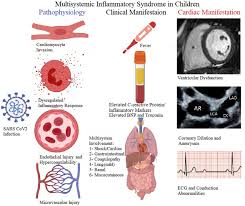 Image result for Multisystem Inflammatory Syndrome