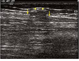 Muscle Hernia In A 23 Year Old Woman Who Complained Of A Palpable Download Scientific Diagram