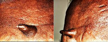 Image result for cornu cutaneum)