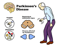We did not find results for: Parkinson S Disease May Be Stopped