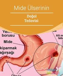 Mide Ulserinin Dogal Tedavisi Gastrik Ulser Ya Da Bilinen Adiyla Mide Ulseri Midenin Mukoza Dokusunda Meydana Gelen Yaralara Ver Health Health Care Disease