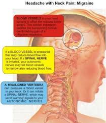 Pin On Migraines Headaches