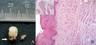 A rare cause of bronchial occlusion. Leiomyomatous Hamartoma Report Of Two Cases And Review Of The Literature Oral Surgery Oral Medicine Oral Pathology Oral Radiology And Endodontics
