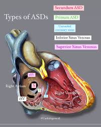 Image result for Atrial Septal Defect