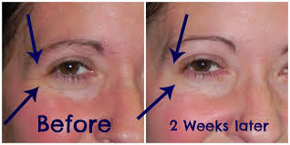 Does botox help with lines around the eyes? What Happens When You Get Botox For The First Time