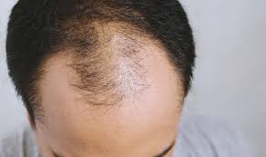 This tree produces saw palmetto berries; Best Supplements For Men Saw Palmetto May Stop Hair Loss And Boost Prostate Health Express Co Uk