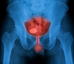 Immediate Instillation Of Mitomycin C Post Turbt May Benefit All Patients With Bladder Cancer Cancer Therapy Advisor