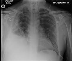 Image result for Flail Chest