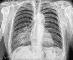 Il peut être localisé à une partie du poumon ou s'étendre à l'ensemble de l'appareil pulmonaire. Pneumonies Et Pneumopathies Infectieuses De L Adulte Thoracotomie