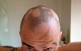 There are several patterns of natural and disease related hair loss. 5 Causes Of Alopecia And How To Fix Them Team Micro
