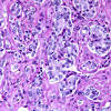 What causes prostate cancer is still not known exactly but, researchers have found some risk factors and are making progress toward understanding how this procedure helps show whether the cancer has spread from the prostate gland to bones. Https Encrypted Tbn0 Gstatic Com Images Q Tbn And9gcsyr1ykhwbtakruggfqr7lap Ab5zwa5jr2js9lm6d6kaqk8lee Usqp Cau