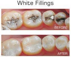 Your dentist may instruct you to avoid eating on that side of your mouth for a few hours after the appointment, as it takes time for a temporary filling to completely dry and set. 5 Benefits Of White Fillings Dentist In Bounds Green Dental Blog Brightside Dental
