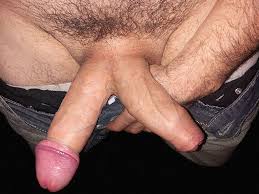 Diphallia: luomo nato con due peni [FOTO] | MEDICINA ONLINE