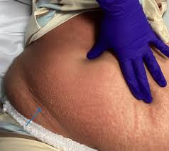 Image result for pruritic urticarial papules and plaques of pregnancy