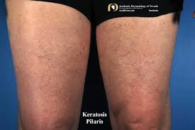 Image result for Keratosis pilaris