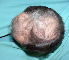 For most men with male pattern hair loss (androgenic alopecia), keeps works to stop hair loss and regrow hair. How Eucapil Works Eucapil Shop Deutschland Hair Care Agent For Topical Use In Androgenetic Alopecia Hair Loss