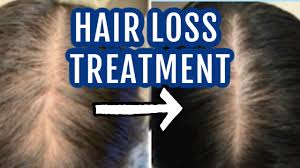 Doctor increase dosage to 50mg twice daily for 6 months = free testosterone is at 7.9, slightly less facial hair, facial skin is clear and smooth (previously had orange peel skin), slightly less oily skin too, no weight gain. Spironolactone For Hair Loss Dr Dray Youtube